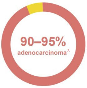 La Mayoría de los Cánceres de Estómago son Adenocarcinomas