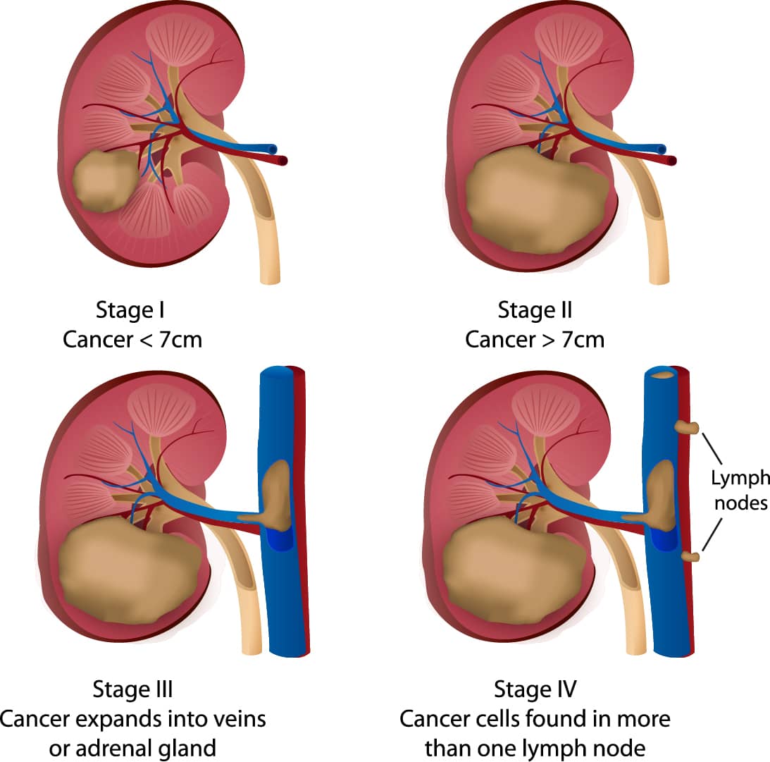 Etapas del cáncer de riñón con tumor en crecimiento