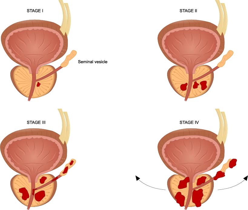 Ilustración de etapas del cáncer prostático