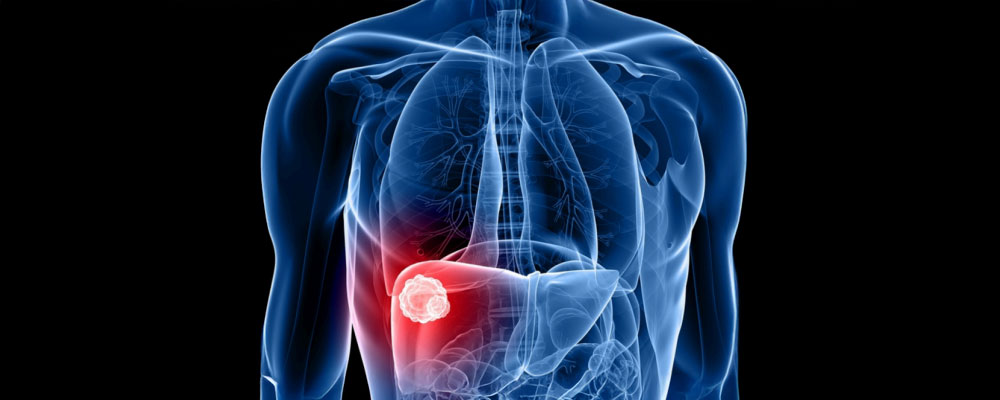 Representación Anatómica de Tumor Hepático