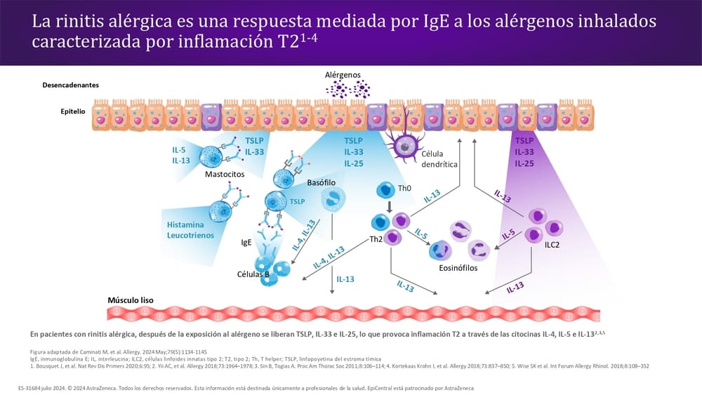 La rinitis membrana mucosa de las fosas nasales