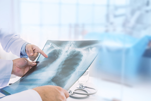 Radiografía de los pulmones