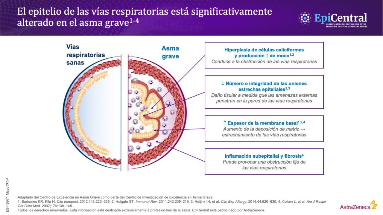 Cambios en el epitelio de las vías respiratorias en asma grave