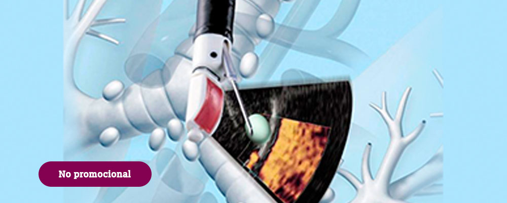 Broncoscopia mediante ecografía endobronquial - EBUS
