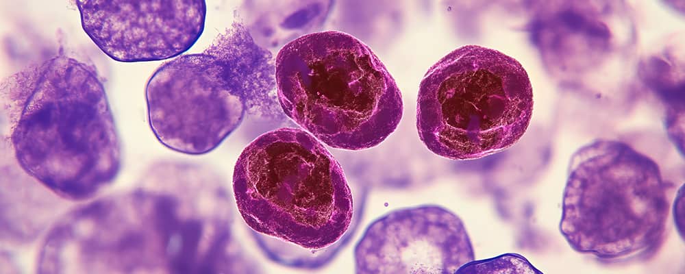 Leucemia Linfocítica Crónica - Imagen Destacada
