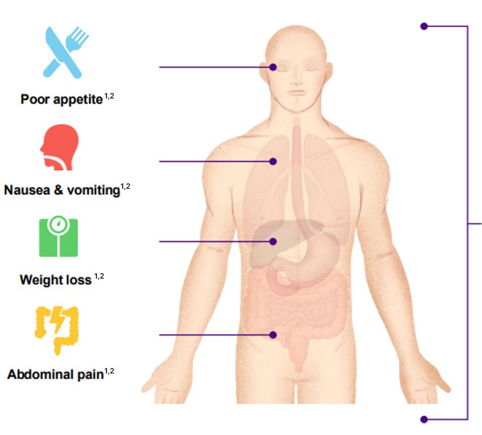 Ilustración de los Síntomas más Comunes del Cáncer de Estómago.