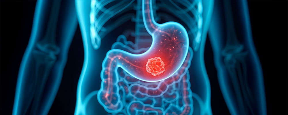 Ilustración del cáncer gástrico en el estómago.