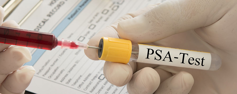 Prueba de PSA para el cáncer de próstata