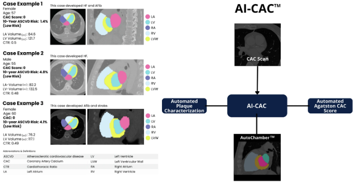 Ilustración del sistema AI‑CAC con escaneos CAC que se introducen en la caracterización automatizada de placas y la puntuación Agatston, junto con tres ejemplos de casos que muestran la segmentación codificada por colores de las cavidades cardíacas en imágenes.