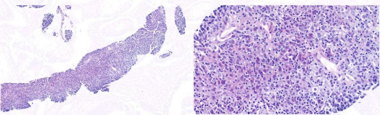 Carcinoma de Pulmón de Células no Pequeñas