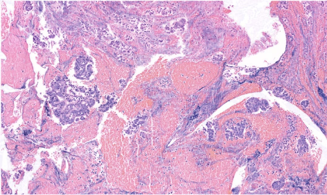 Célula Tumoral de Adenocarcinoma de Páncreas