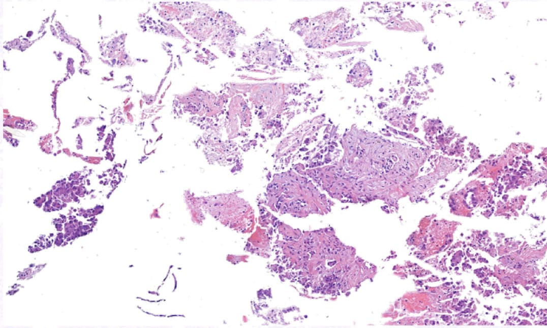 Célula Tumoral de Carcinoma de Pulmón de Células no Pequeñas